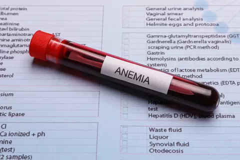 Ciągłe zmęczenie? To może być anemia!
